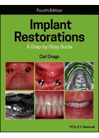 Implant Restorations : A Step-by-Step Guide  John Wiley and Sons Ltd   John Wiley and Sons Ltd 