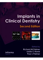 Implants in Clinical Dentistry 2nd Edición CRC Press CRC Press
