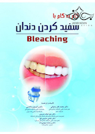 گام به گام با سفید کردن دندان Bleaching