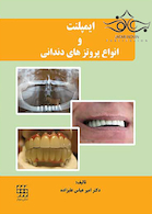 ایمپلنت و انواع پروتزهای دندانی