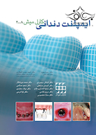 ایمپلنت دندانی میش فصول عمومی