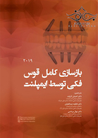 بازسازی کامل قوس فکی توسط ایمپلنت 2019