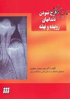 خارج نمودن دندانهای روییده و نهفته