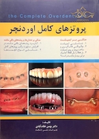 پروتزهای کامل اوردنچر