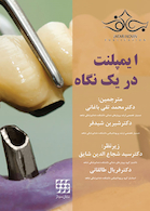 ایمپلنت در یک نگاه