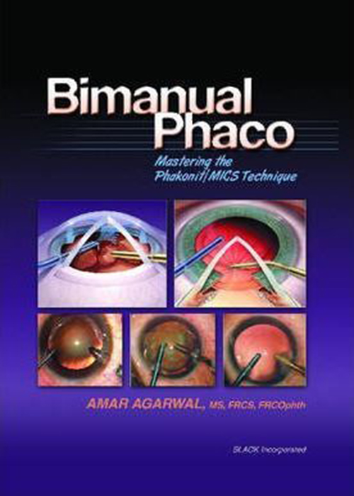Bimanual Phaco: Mastering the Phakonit/MICS Technique2004  SLACK Incorporated