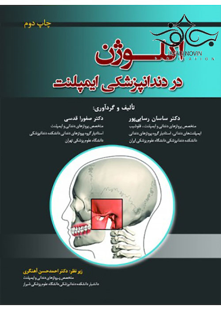 اکلوژن در دندانپزشکی ایمپلنت