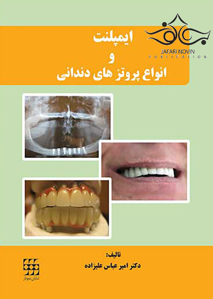 ایمپلنت و انواع پروتزهای دندانی