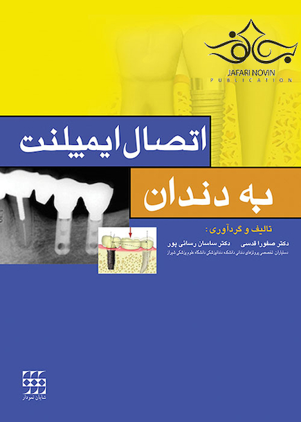 اتصال ایمپلنت به دندان