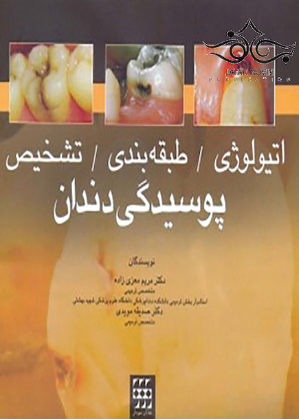 اتیولوژی طبقه بندی تشخیص پوسیدگی دندان