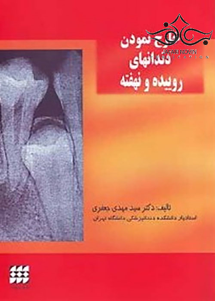 خارج نمودن دندانهای روییده و نهفته