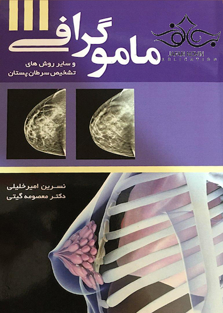 ماموگرافی وسایر روش های تشخیص سرطان پستان
