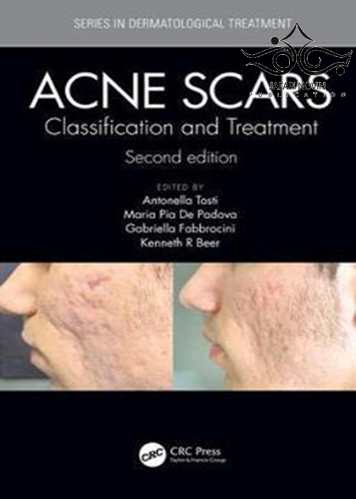 Acne Scars: Classification and Treatment, 2nd Edition Taylor- Francis Inc