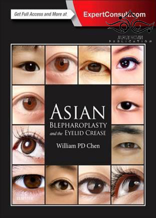 Asian Blepharoplasty and the Eyelid Crease 3rd Edition ELSEVIER