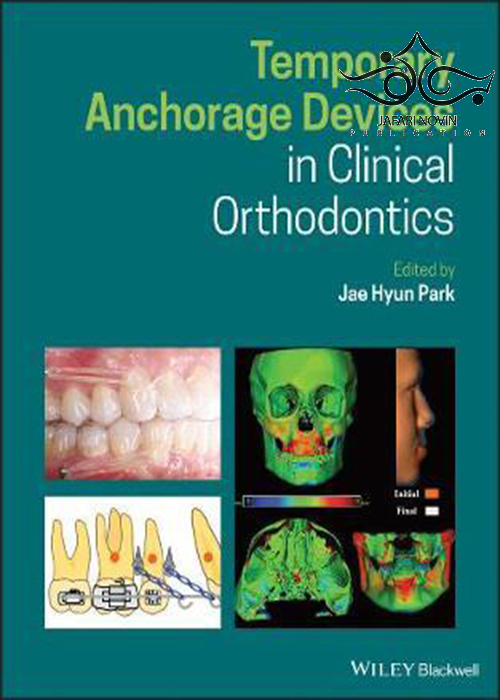 Temporary Anchorage Devices in Clinical Orthodontics  John Wiley and Sons Ltd 