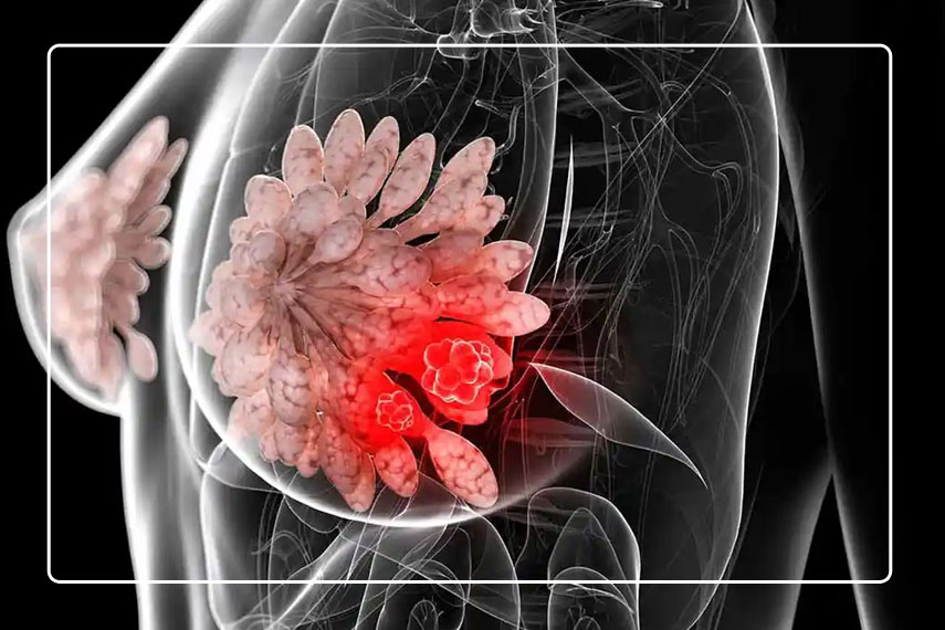 سرطان‌های مرتبط با ژن‌های BRCA1 