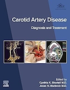 Carotid Artery Disease: Diagnosis and Treatment | بیماری شریان کاروتید: تشخیص و درمان