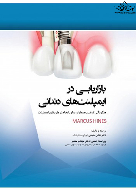 بازاریابی در ایمپلنت های دندانی چگونگی ترغیب بیماران برای انجام درمان های ایمپلنت