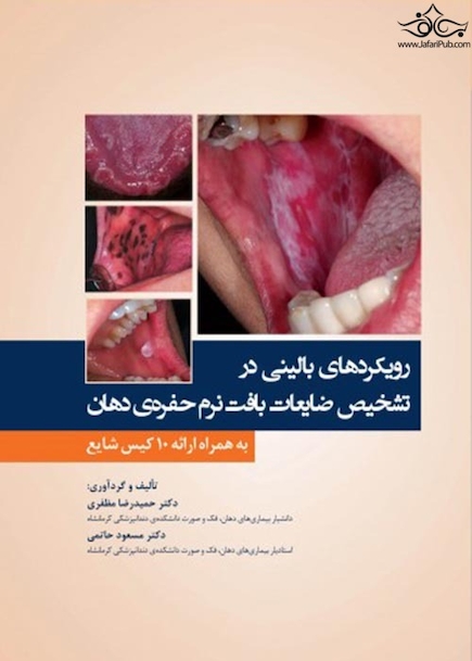 رویکردهای بالینی در تشخیص ضایعات بافت نرم حفره ی دهان به همراه ارائه 10 کیس شایع