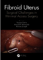 Fibroid Uterus: Surgical Challenges in Minimal Access Surgery2020فیبروئید رحم