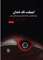 ایمپلنت تک دندان 2020