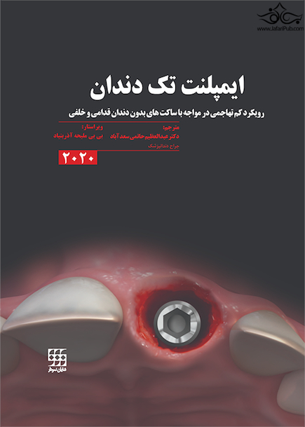 ایمپلنت تک دندان 2020