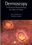 Dermoscopy in General Dermatology for Skin of Color2021
