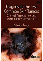 Diagnosing the Less Common Skin Tumors : Clinical Appearance and Dermoscopy Correlation2019