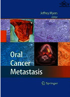 متاستاز سرطان دهان | Oral Cancer Metastasis2010