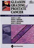 درجه بندی سرطان پروستات | Gleason Grading of Prostate Cancer : A Contemporary Approach
