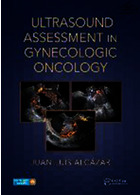 ارزیابی سونوگرافی در سرطان زنان | Ultrasound Assessment in Gynecologic Oncology