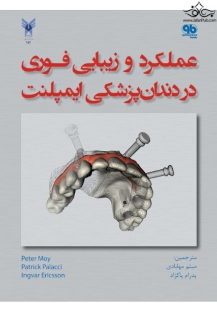عملکرد و زیبایی فوری در دندانپزشکی ایمپلنت