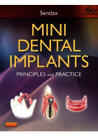 Mini Dental Implants : Principles and Practice | مینی ایمپلنت های دندانی