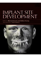 Implant Site Development | توسعه  ایمپلنت