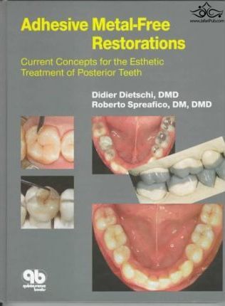 Adhesive Metal-Free Restorations : Current Concepts in the Aesthetic Treatment of Posterior Teeth  Quintessence Publishing Co Inc.,U.S