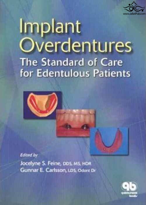 Implant Overdentures as the Standard of Care for Edentulous Patients  Quintessence Publishing Co Inc.,U.S