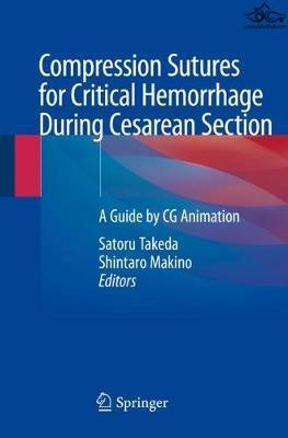 Compression Sutures for Critical Hemorrhage During Cesarean Section Springer
