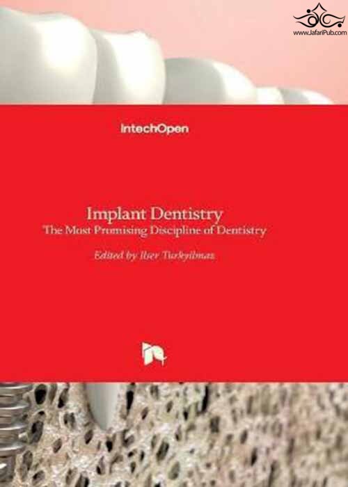 Implant Dentistry : The Most Promising Discipline of Dentistry  In Tech 