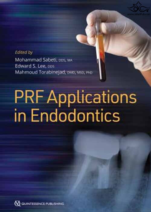 Platelet-Rich Fibrin Prf Applications in Endodontics  Quintessence Publishing Co Inc.,U.S