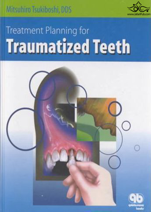 Treatment Planning for Traumatized Teeth  Quintessence Publishing Co Inc.,U.S