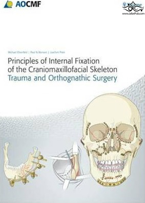 Principles of Internal Fixation of the Craniomaxillofacial Skeleton : Trauma and Orthognathic Surgery 2012 Thieme