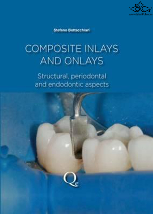 Composite Inlays and Onlays : Structural, Periodontal, and Endodontic Aspects  Quintessence Publishing Co Inc.,U.S