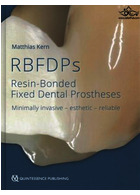 Rbfdps : Resin-Bonded Fixed Dental Prostheses: Minimally Invasive - Esthetic - Reliable | پروتزهای دندانی ثابت متصل به رزین