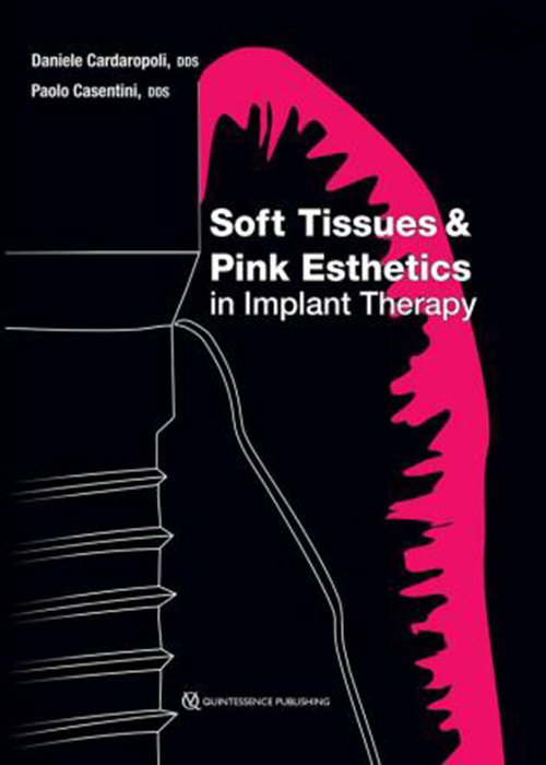 Soft Tissues & Pink Esthetics in Implant Therapy  Quintessence Publishing Co Inc.,U.S
