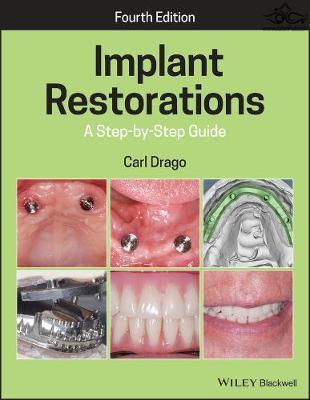 Implant Restorations : A Step-by-Step Guide  John Wiley and Sons Ltd 
