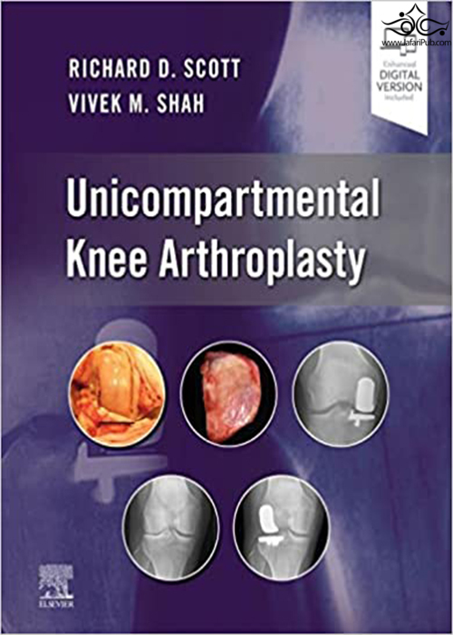 Unicompartmental Knee Arthroplasty ELSEVIER