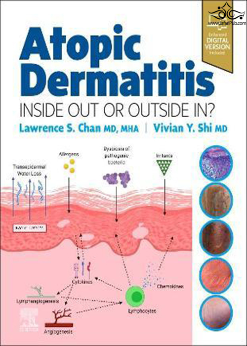 Atopic Dermatitis: Inside Out or Outside In ELSEVIER