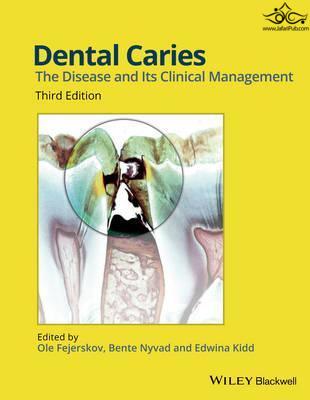 Dental Caries: The Disease and its Clinical Management 3rd Edición John Wiley-Sons Inc