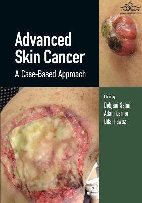 Advanced Skin Cancer: A Case-Based Approach  ‎ CRC Press