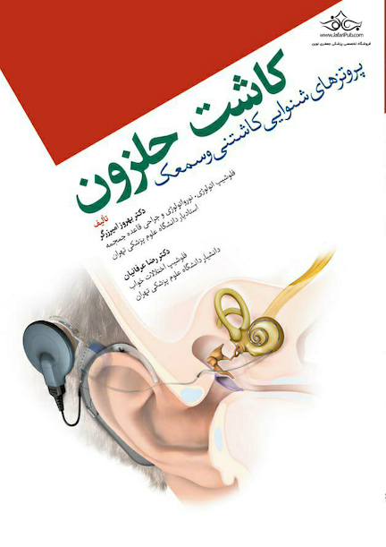 کاشت حلزون